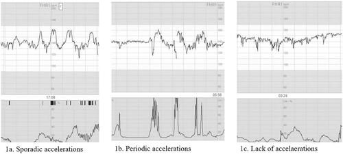 Figure 1. Accelerations as defined in the study. (a) Sporadic accelerations, with a raise in basal heart line of at least 15 beats per minute, lasting for at least 15 s and occurring without relation to contractions. (b) Periodic accelerations, with a raise in basal heart line of at least 15 beats per minute, lasting for at least 15 s and occurring simultaneously with contractions. (c) No transient raises in basal heart line fulfilling the definition of accelerations.
