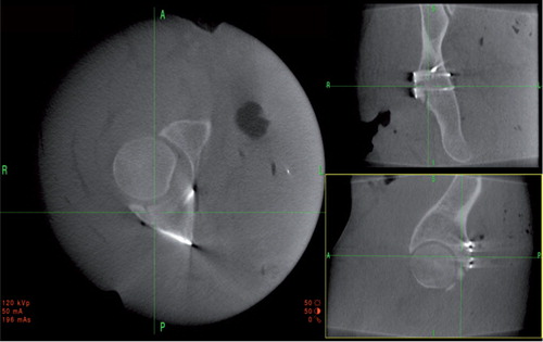 Figure 3. Intraoperative 2D reconstructions of a reduced and stabilized posterior wall fracture. Axial view to the left, coronal view to the upper right, and sagittal view to the lower right. This clearly shows good reduction and extra-articular screw placement.