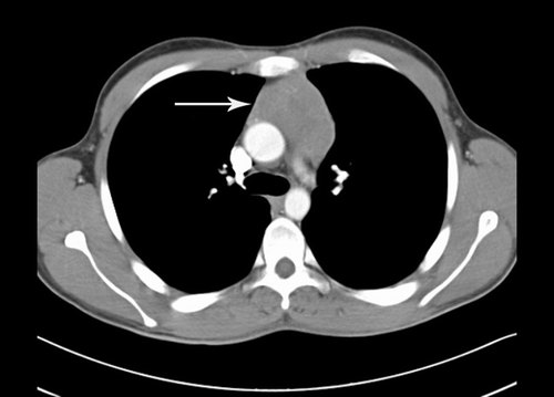 Figure 1.  Axial CT scan of the chest with IV contrast showing a large anterior mediastinal soft-tissue mass measuring approximately 6.5 x 4.5 cm (depicted by white arrow).