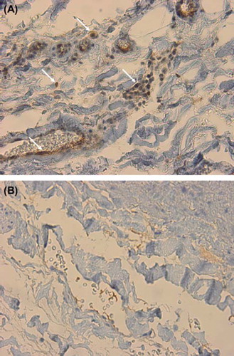 Figure 1. Representative photograph (× 40) of aortic adventitial wall immunohistochemistry of C4d during ascending aortic dilatation (A) and during ascending aortic dissection (B). Note positive C4d staining (arrows) in A suggesting stabile aortic wall during aortic dilatation.