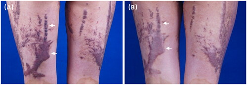 Figure 5. A 32-year-old burn female with hypertrophic scars from on lower limbs at (A) baseline and (B) 3 months after three IPL treatments showing good changes in vascularization and thickness.