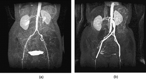 Figure 6. MIP of preoperative and postoperative MRA for a 67-year-old female. (a) The extent of the occlusive disease preoperatively (notice the tight stenosis in the patient's left external iliac) and (b) the bypass graft and the occlusion of the external iliac arteries postoperatively.