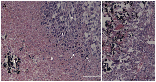 Figure 6. Histological analysis (HE) of the tumour from the treatment group (left image) and control group II (right image). Treatment group: the upper right corner shows the neoplastic cells (A) with areas of necrosis (B), inflammatory infiltrate (C) composed mainly of lymphocytes and plasma cells (arrows); in the lower left corner, the ferrimagnetic material (D). Control group II: the image's right site shows the tumour cells (A), some inflammatory infiltrate (B) and small necrotic areas (C) associated with FC (D). Bar = 12.5 µm.
