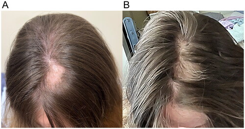 Figure 3. (A,B) Before (week 0) and after (week 12) photographs of alopecia areata of the vertex scalp.