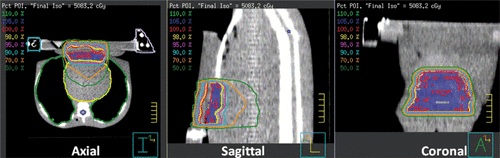 Figure 3. Twelve-beam IMRT plan dose distributions on the axial, sagittal and coronal planes through the PTV and SURLAS applicator. An MVCT of the RANDO phantom with the SURLAS on top simulating a typical clinical set-up for the treatment of chest wall recurrence of breast cancer was used as the planning CT.