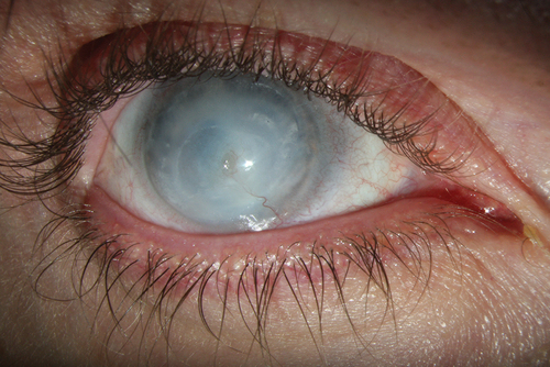 Figure 2. Exterior image from 30-year-old patient displaying dense corneal opacities with growth of vessels in the right eye which was blind after repeated surgery for retinal detachment after ectopia lentis.