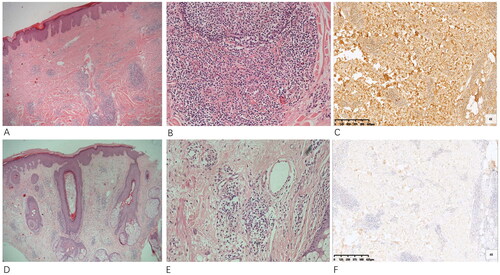 Figure 2. Histopathology of the back specimen (A,B) and the nose specimen (D,E) revealed a lymphohistiocytic infiltrate with eosinophil and plasma cell accumulation with numerous vessels. Immunoperoxidase staining for IgG (C) and IgG4 (F) shows more than 50 positively staining plasma cells per high-powered field with an IgG to IgG4 ratio close to 40%.