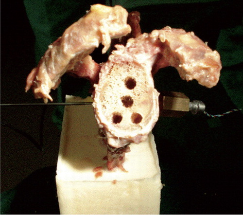 Figure 3.  Frontal view of a prepared glenoid with the pressure sensor on the coracoid side and the temperature sensor on the spina side.