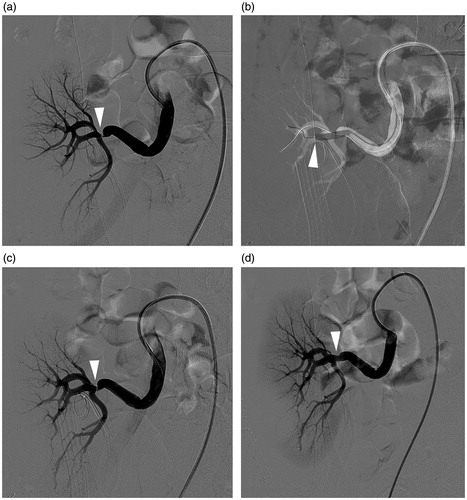 Figure 2. (a–d) A 33-year-old male with elevated serum creatinine level 6 days post-operatively. (a) Angiography showed about 80% stenosis (arrowhead) at the distal part of transplant renal artery near the renal hilum. (b) Balloon dilation was primary performed. Notice that the balloon diameter was selected in according with distal segmental artery (arrowhead). (c) Over 30% stenosis (arrowhead) was left after balloon dilation. (d) A balloon-expandable stent was deployed with almost no residual stenosis (arrowhead) left.
