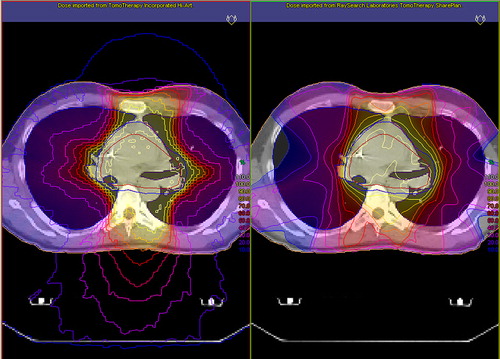 Figure 1. A screen capture showing how the dose distribution for treatment plans were presented side-by-side for the radiation oncologists, in the Oncentra treatment planning system. To the left is the helical tomotherapy plan, and to the right the step-and-shoot intensity-modulated radiation therapy plan, for treatment of an intrathoracic tumor (case I 3).