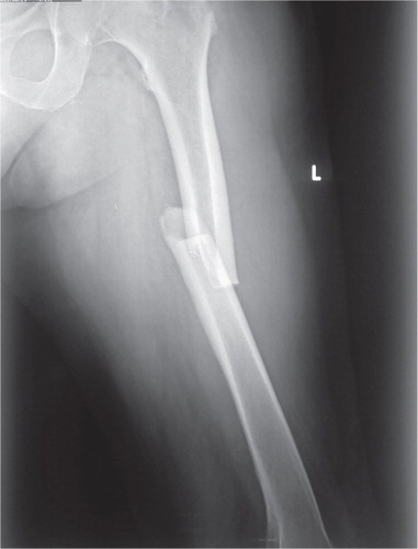 Figure 1. The patient’s left femur at the time of the first fracture. A transverse femoral shaft fracture with lateral cortical hypertrophy and medial spiking.