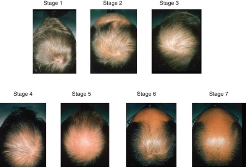 Figure 2. Progressive hair loss in the crown in advancing stages, with relative sparing of the occipital hair.