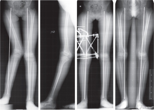 Figure 7. A patient with complex deformity after physeal injury (fixator group: pair 11). Initial deformity parameters included shortening, valgus and recurvatum deformity in the femur. The radiographs from latest follow-up (far right) show some overcorrection into varus deformity on the affected side.