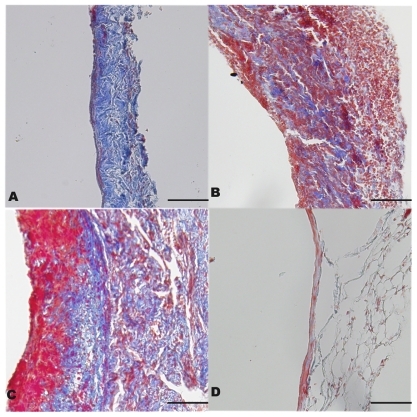 Figure 3 Pathologic examination of vein grafts and normal veins with Masson stain (original magnification 200×). A) Group 1 (rapamycin-loaded PLGA nanoparticle vein graft perfusion), B) Group 2 (empty vehicle), C) Group 3 (vein graft with no treatment), and D) Group 4 (sham operation, normal vein). In these figures, the collagen was dyed to red. Bar = 100 μm.Abbreviation: PGLA, poly lactic-co-glycolic acid.