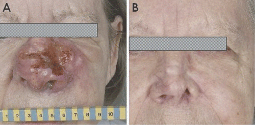 Figure 1. A patient with a desmoplastic melanoma of the nose before (A), and seven months after (B) treatment with radiotherapy (5 × 6 Gy) and hyperthermia (three treatments).