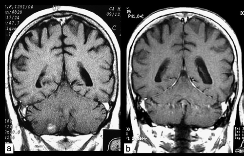 Figure 1.  Coronal T1W contrast-enhanced image. Patient 1. a) Magnetic resonance imaging scan of solitary occult subtentorial brain metastasis before radiotherapy. b) Complete remission 3 months after whole-brain radiotherapy.