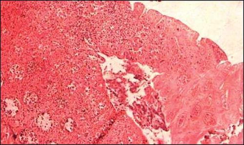 Figure 3.  Photomicrograph showing infarcted colonic mucosa in ischemic colitis with adjacent mucosal hemorrhage, hematoxylin eosin stain, 200×.
