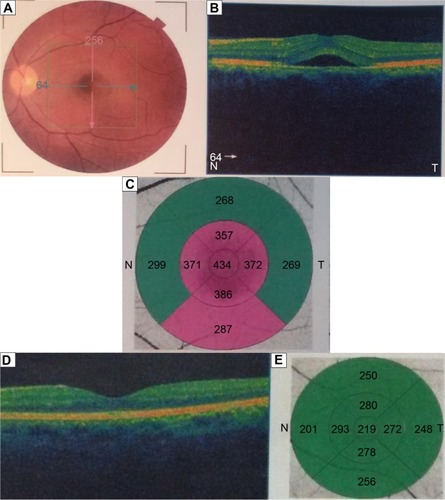 Figure 4 A patient with central serous chorioretinopathy of the left eye.