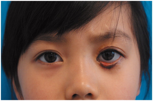 Figure 2. Two years after the laser treatment, ectropion of left lower eyelid persisted, with residual nevus, hyperpigmentation and asymmetric double eyelid height.