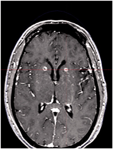 Figure 4. Axial T1-weighted MRI sequence demonstrating bilateral anterior capsulotomy using stereotactic radiosurgery for obsessive-compulsive disorder. MRI: magnetic resonance imaging.