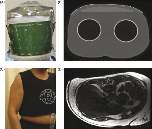 Figure 3. CMA applicator conformity to contoured chest wall: (A) Photo of 18-element DCC array coupled with 9-mm thick water bolus to torso phantom, (B) CT scan cross section of torso phantom through one row of the 18 element DCC array, (C) Elastic outer support vest, (D) MR scan showing conformal water bolus on a mastectomy patient.