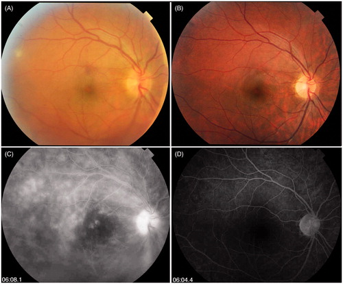 FIGURE 2. (A) Fundus photo of eye number 5 showing significant vitreous haze and inferior vitreous hemorrhage secondary to inferior neo-vessel. (B) Complete resolution of vitreous haze and inferior neo-vessel on last follow-up. (C) Late frame of fluorescein angiography of eye 5 showing diffuse optic disc hyperfluorescence, macular edema with pooling of dye in cystic spaces, diffuse retinal vascular staining, and diffuse capillary leakage in the posterior pole. (D) Complete resolution of leakage on last follow-up.