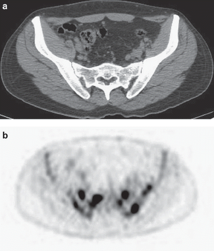 Figure 3. Unremarkable CT scan of lower abdomen and pelvis (a) compared to intense uptake in the sacrum and pelvic bones on PET/CT (b).
