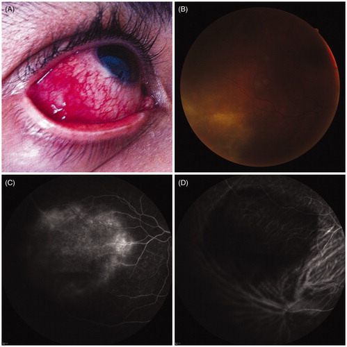 Figure 1. (A) Initial presentation: a painful nodular scleritis is present at the equator of the globe (B) Fundus picture: retinis and arteriovenous occlusive aspect (C) Fluorescein angiography early transit phase revealing a diffuse leakage with occluded vessels and some pinpoints (D) ICG angiography early transit phase revealing a large hypo-fluorescent zone toward the scleritis.