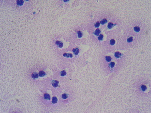 Figure 1.  Preparation of synovial fluid showing numerous mature myeloid cells and occasional promyelocytes. (Giemsa×100)