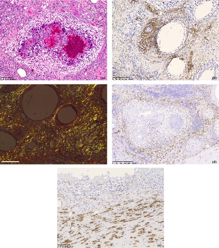 Figure 4. (a) Large vacuoles likely representing remnants of inactivated oil-emulsion vaccine surrounded by macrophages, multinucleated giant cells, plasma cells, lymphocytes, and heterophils with fibrosis. HE stain. (b) Amyloid shown in the surrounding of the large vacuoles likely representing remnants of inactivated oil-emulsion vaccine at the injection sites of treated chickens. Immunohistochemistry with MX-AA antibodies. (c) Amyloid appears as apple-green birefringence in a tissue sample of the injection site of a chicken when viewed with polarized light under a light microscope. Congo red stain. Scale bar = 100 μm. (d) SAA mRNA is abundantly shown in the periphery of granulomas at the injection site in treated chickens. In situ hybridization. (e) High magnification of Figure 4(d) shows that the positive signals are detected in spindle-shaped cells. In situ hybridization.