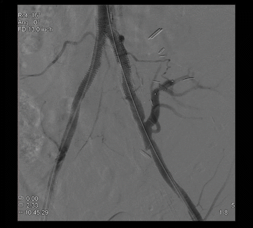 Figure 3. Completion aortogram demonstrating successful angioplasty and stent deployment with a good technical result.