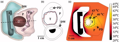 Figure 9. (a) 3D model of the Example 1 anatomy, consisting of a small pancreatic head tumour directly adjacent to the duodenal lumen and positioned applicator. (b) 240 EM43 °C contours for ablation simulations using a 2 MHz planar (dashed contour) and 2 MHz lightly focused curvilinear transducer with a 25 mm ROC (dotted contour) across the central transverse slice through the applicator. (c) Temperature distributions and 40 and 43 °C contours (grey with dashes) are given for a hyperthermia simulation using a 1 MHz tubular section transducer. A: applicator, T: tumour, P: pancreas, DW: duodenal wall, PD: pancreatic duct.