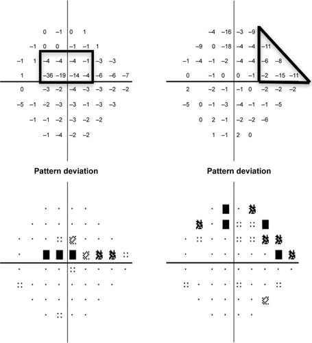Figure 1 Examples of patterns of VF loss on HVFs (Swedish Interactive Threshold Algorithm 24-2) as defined in this study.