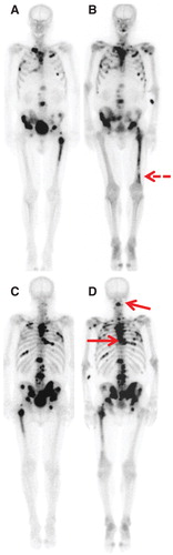 Figure 2. Whole-body [99mTc]bisphosphonates (HDP) bone scans for patient no. 13: pretreatment (left column A and C) and post-treatment (right column B and D), with anterior views (upper row A and B) and posterior views (lower row C and D). Development of new/expansion of existing lesions (n = 24) and concomitant reduced HDP uptake in pretreatment known lesions. Arrows point to C2 and Th7, further visualized by FACBC positron emission tomography/computed tomography; this examination was not available for the left thigh (broken arrow).