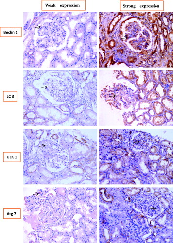 Figure 4. Representative findings on immunohistochemical staining of renal biopsy specimens from patients with LN with antibodies against Beclin1, microtubule-associated protein light chain 3 (LC3), and UNC-51-like kinase 1 (ULK1) autophagy-related gene 7 (Atg7). The arrows pointed to the positive signals.