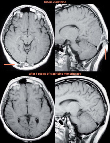 Figure 2. T1 weighted MRI scans of the brain in transverse (left) and sagittal (right) planes after application of contrast agent in Case 2. Due to incipient eyesight deterioration and increased tracer uptake in the occipital region on bone scintigraphy, the patient was sent to MRI which revealed an osteolytic lesion infiltrating the meningeal membranes near the occipital lobe. The function of the centre of vision which is located in the occipital lobe was deteriorated in this patient by intracranial propagation of LCH. After cladribine treatment the infiltration receded, which was followed by a complete vision recovery.