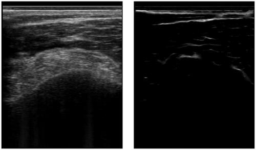 Figure 2. An example of an ultrasound image and its respective phase symmetry (PS) image. Note, that the bone surface on the left has a rather asymmetric appearance due to the hyperechoic soft tissue on top. This is why the bone surface is barely recognized.