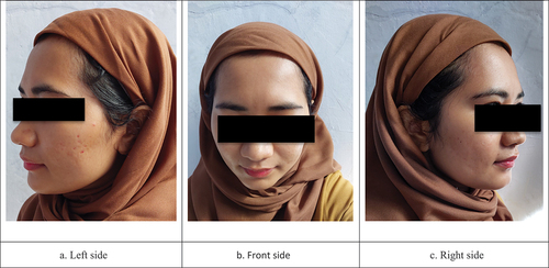 Figure 4. Photo of the face 6 month after RFM treatment, chemical peel and LED therapy completed. The tram-track scarring were completely recovered.