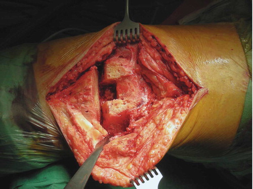 Figure 3. After preparation of distal femur and proximal tibia using the standard cutting blocks.