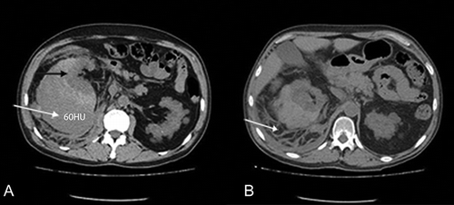 Figure 1.  Computed tomography scan on admission: (A) giant subcapsular hematoma, increased density of 60 Hounsfield Units (white arrow) depressing the right kidney upward (black arrow) and (B) perirenal fluid (arrow).