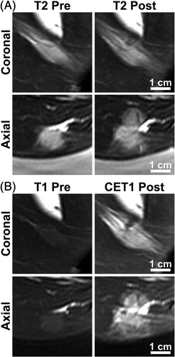 Figure 2. MRI detection of tissue damage in a tumour-bearing rabbit treated with hyperthermia and thermosensitive liposomal doxorubicin. The rabbit that received a thermal dose of 26.5 equivalent min at 43°C is shown. (A) T2-weighted images in coronal (top) and axial (bottom) planes through the tumour, acquired prior to treatment (left) and following treatment (right). (B) T1-weighted images in the same imaging planes. Gadolinium contrast agent was injected immediately before acquiring post-treatment T1-weighted images.