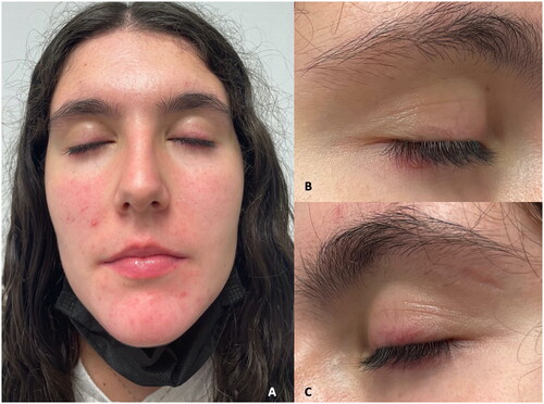 Figure 2. Clinical picture after treatment. (A) Face overview with less papules and pustules. (B) Close view of the right eye. (C) Close view of the left eye.