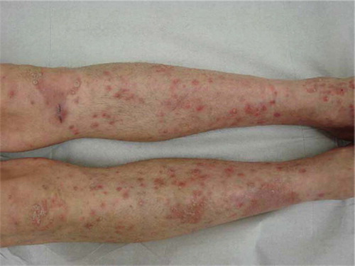 Figure 2. Patient 3: Exacerbation of sharply demarcated erythematosquamous plaques and many pin-point psoriatic papules, designated as psoriasis.