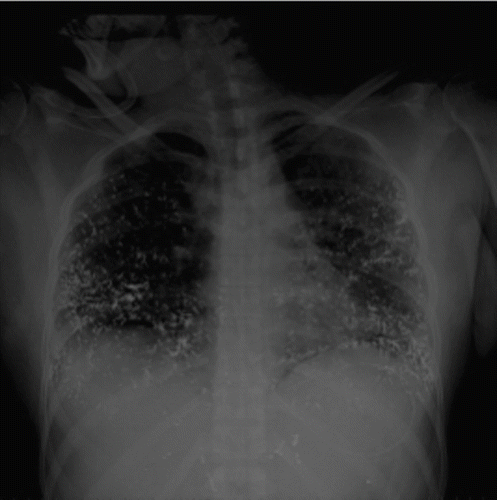Fig. 1.  Antero-posterior chest X-ray film at admission.