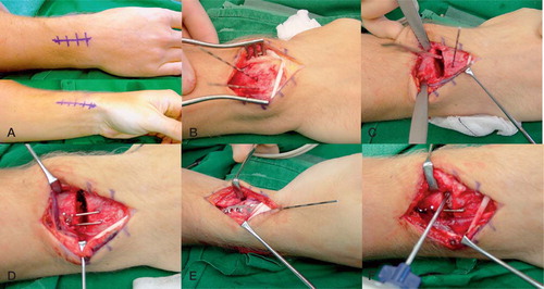 Figure 2 A. The operation was carried out with the arm in a prone position. 2 short incisions were made, one radially through the first extensor compartment and a second dorsal incision through the fourth compartment. B. The joint line was marked with 2 parallel pins into the distal radius and the holes were later used for the dorsal buttress pin. C. The osteotomy was then performed with an oscillating saw and the malposition reduced. A temporary fixation was achieved by a pin driven through the radial styloid and into the radius, proximal to the osteotomy, thereby bridging the osteotomy. D. When optimal positioning was accomplished, the fixation was secured by the dorsal buttress pin and the radial pin plate (E). F. Norian SRS was injected into the bone defect and left to harden as the extensor retinaculum and skin were closed. A bulky dressing and a dorsal cast completed the operation.