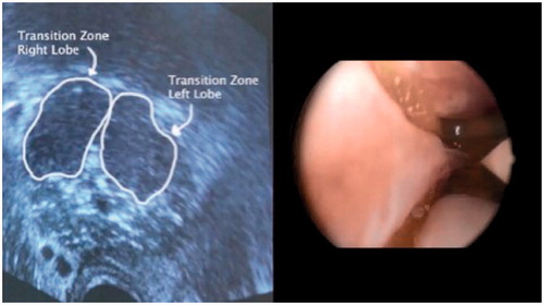 Figure 3. Uniquely contained within prostate anatomy. Images from Michael Hoey, Ph.D. Chief Technology Officer, NxThera Inc. Rezum Pilot Study.