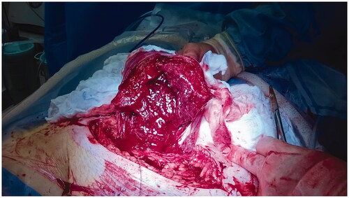 Figure 1. J-incision in a preterm breech caesarean section in pregnancy week 24.