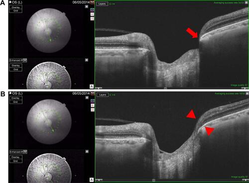 Figure S2 Example of a left eye with early paracentral loss.Notes: The corresponding visual field test is shown in Figure 1 left side. The minimal BMO-MRW is 34.8 μm and the minimal sector BMO-MRW, as an average over three adjacent scans, is thicker at 92.4 μm. (A) Minimal BMO-MRW (34.8 μm) is in the inferotemporal sector (red arrow) on scan 6. (B) BMO-MRW in the inferotemporal sector (red arrowheads) is 109.3 μm on scan 5. (C) BMO-MRW in the inferotemporal sector (red arrowheads) is 133.0 μm on scan 4.Abbreviation: BMO-MRW, minimum rim width at Bruch’s membrane opening.