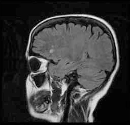 Figure 1 Brain MRI – a single uncharacteristic small focus in hemispheric white matter.