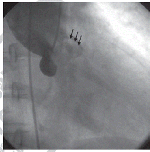 Figure 1. Trans-esophageal echocardiography at short axis view of the basal structure (58° at mid-esophagus). The hypoplastic left coronary cusp (arrows) fails to co-apt during the diastole resulted in aortic regurgitation. LA, left atrium; N, non-coronary cusp; R, right coronary cusp; RVO, right ventricular outflow.
